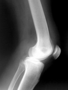 knee xray side view